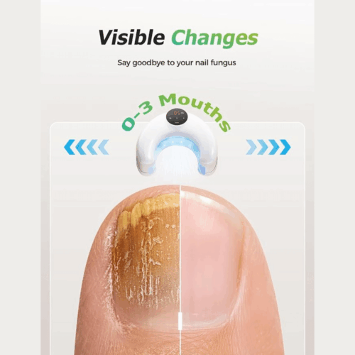 Okita Nail Fungus Light - Official Retailer